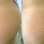 How to get rid of stretch marks on thighs? 10 Home Remedies
