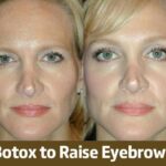 Botox to Raise Eyebrows