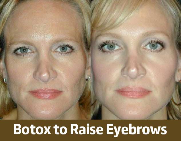 Botox to Raise Eyebrows