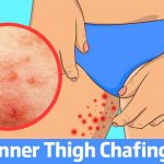 How to Treat Inner Thigh Chafing Faster This Season