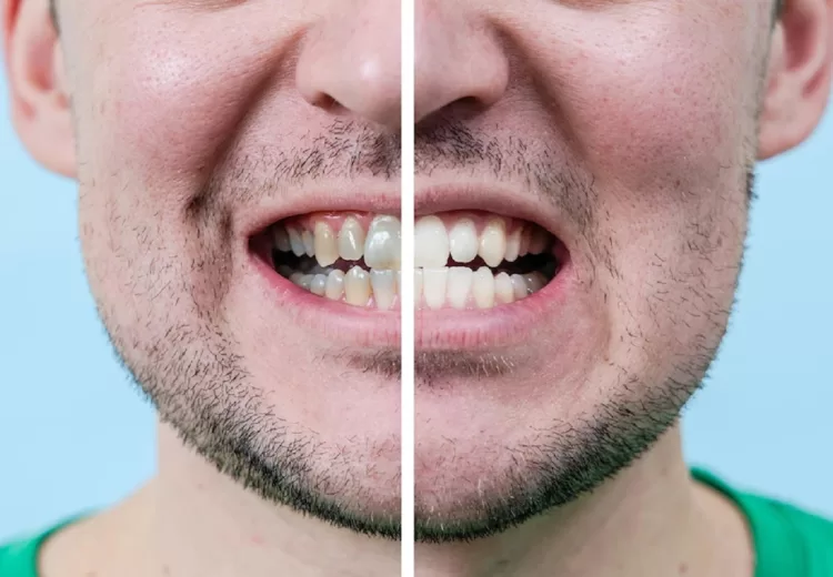 root canal before and after